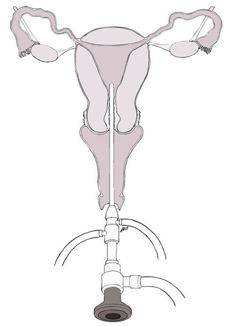 Hysteroscopic Procedure