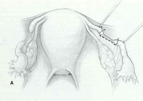 Tubal Anastamosis