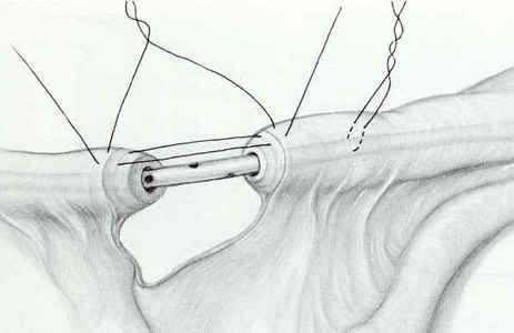 Tubal Anastamosis