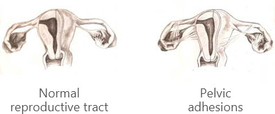 Tubal Disease