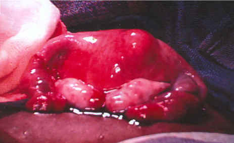 Tubal Anastamosis