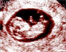 Single pregnancy at eight weeks.