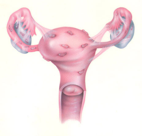 Mild Endometriosis