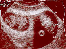 Twin pregnancy at eight weeks.