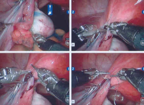 Robotic arms suturing the tubal segments back together.