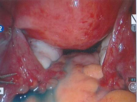 Completed robotic reversal.